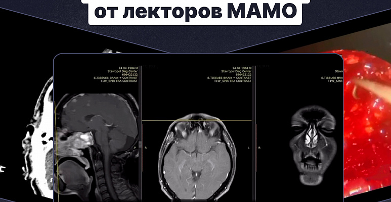 Опыт применения Ботулотоксина -А.